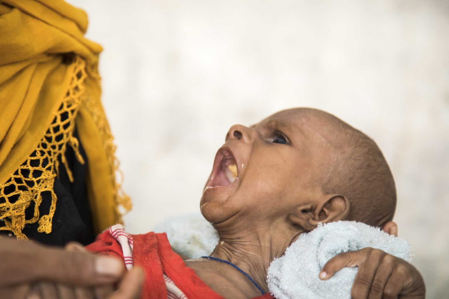 A severely malnourished child cries
